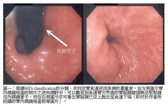 胃食道逆流疾病的認知：一種常見現代文明病〜著重於其多重致病機轉相互關係的探討_圖2