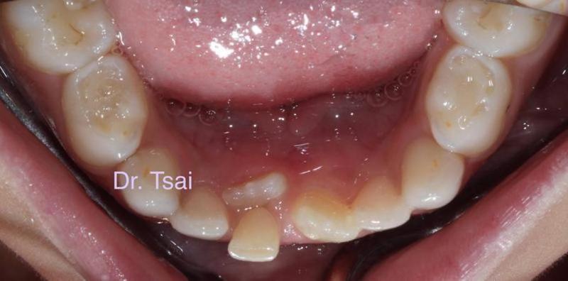 淺談兒童口腔問題 掌握黃金期早期介入兒童牙齒矯正治療_圖1