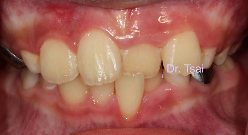 淺談兒童口腔問題 掌握黃金期早期介入兒童牙齒矯正治療_圖2