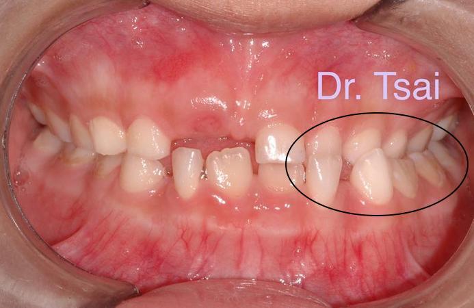 淺談兒童口腔問題 掌握黃金期早期介入兒童牙齒矯正治療_圖3