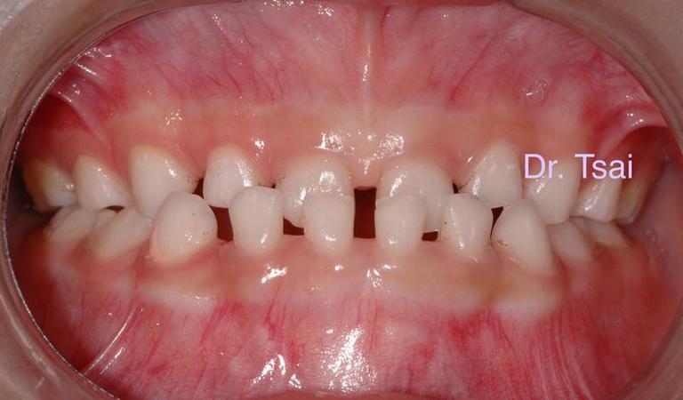 淺談兒童口腔問題 掌握黃金期早期介入兒童牙齒矯正治療_圖4