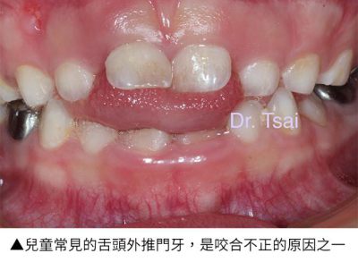 「壞習慣」影響兒童口腔？即早了解兒童矯正與肌功能矯正的必要性