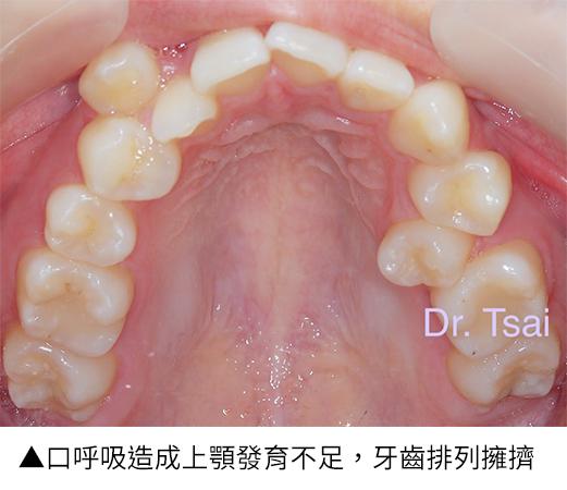 「壞習慣」影響兒童口腔？即早了解兒童矯正與肌功能矯正的必要性_圖4