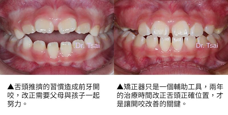 「壞習慣」影響兒童口腔？即早了解兒童矯正與肌功能矯正的必要性_圖5