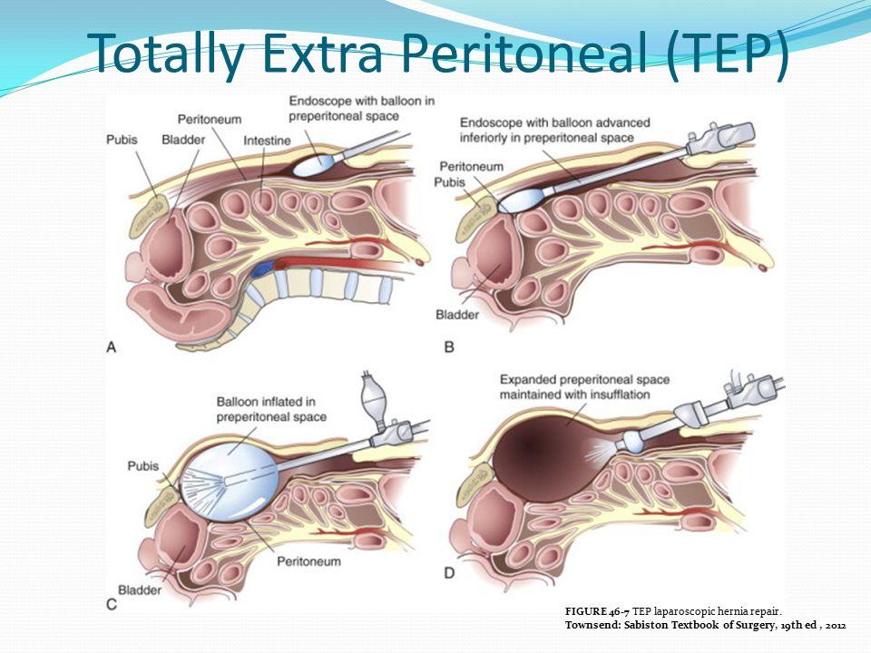 鼠蹊部疝氣_圖4