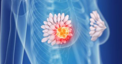 沒懷孕沒餵奶也得乳腺炎？ 醫師說：嬰兒、青少年、男人也會得