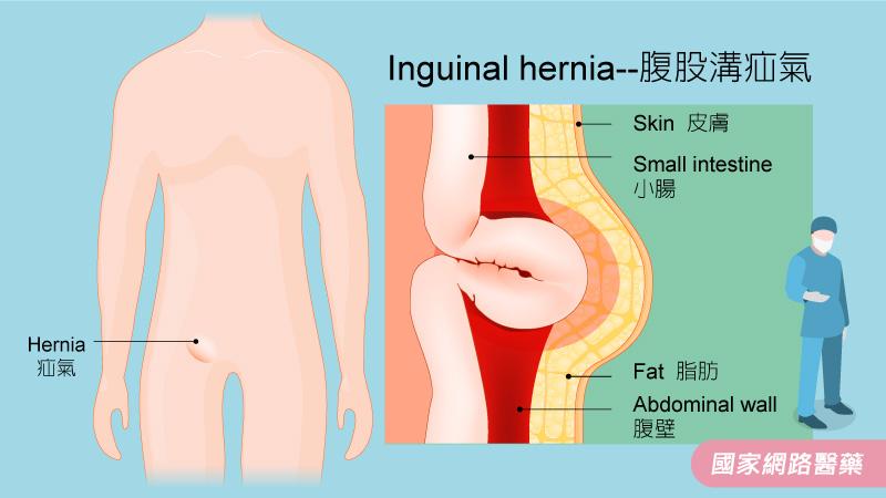 鼠蹊部疝氣_圖2