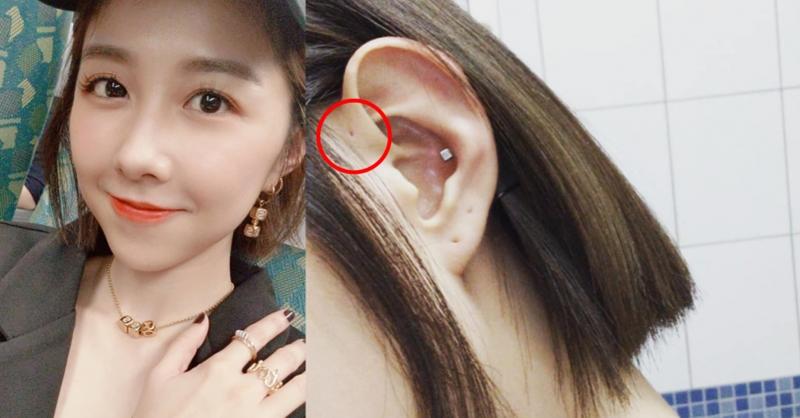 什麼是耳前瘻管是遺傳嗎?構造與清潔保養說明，如果耳前瘻管發臭發炎要動手術嗎?_圖2