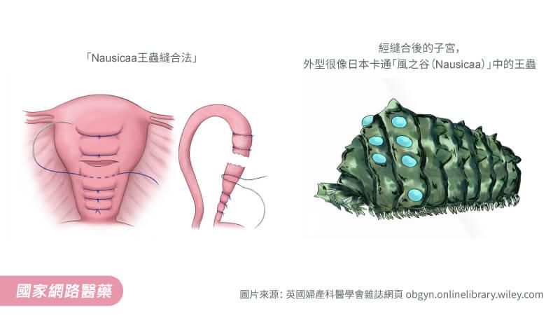 止住產後大出血，讓喜事不變調！臺大醫院發表新技術「Nausicaa王蟲縫合法」_圖2
