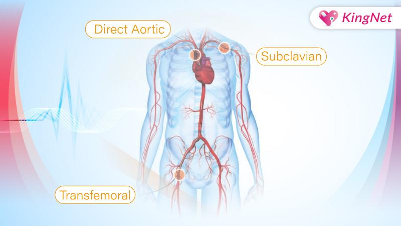 主動脈瓣膜年久失修恐致命！經導管主動脈瓣置換手術為長者續命_圖2