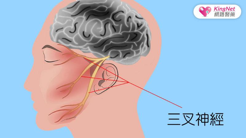 頭痛，痛不欲生！竟是腦內長了「青春痘」！_圖2
