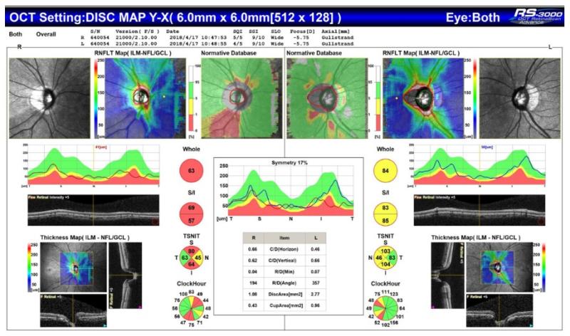 視力的無形殺手 這檢測及早K.O.青光眼_圖2