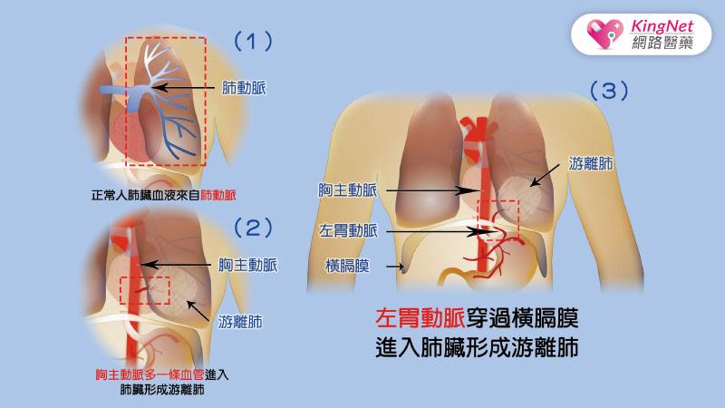 咳血遲遲未癒，竟是這原因導致！_圖2