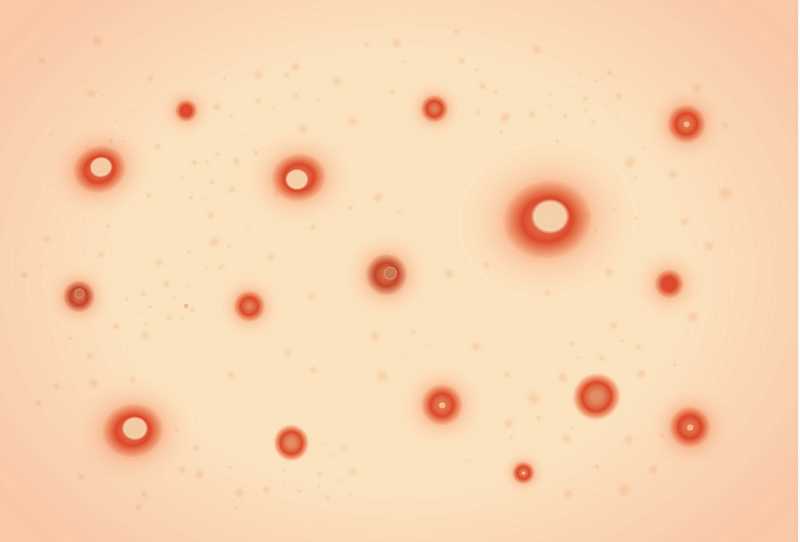 膿包破裂，煩惱消散的夢境示意圖