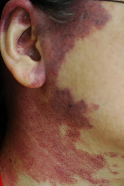 李承鴻醫師|皮膚科|我的文章|個人主頁|KingNet國家網路醫藥