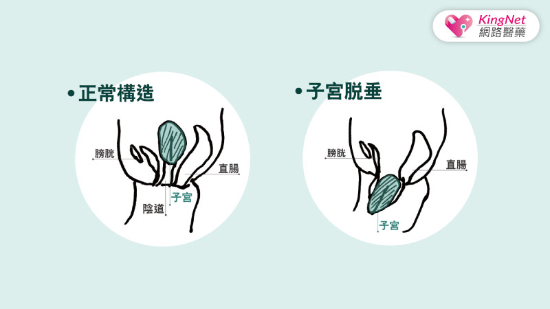 驚！子宮竟從兩腿間掉出來！醫師建議用此方案來治療_圖2