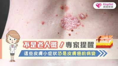 不是老人斑！專家提醒，這些皮膚小症狀恐是皮膚癌前病變