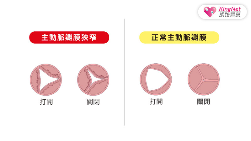 血壓正常，卻老是很喘、胸悶、呼吸困難…醫師提醒：當心「主動脈瓣膜狹窄」成為生命未爆彈_圖2
