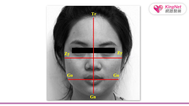 下顎骨角距離與顴骨距離的比例，呈現了正面臉型從上到下向內收斂的幅度(facial taperness)