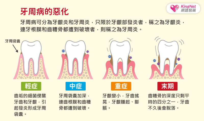 牙齒敏感、蛀牙，除了養成正確刷牙習慣，該如何適當地選擇牙膏成份？！_圖3