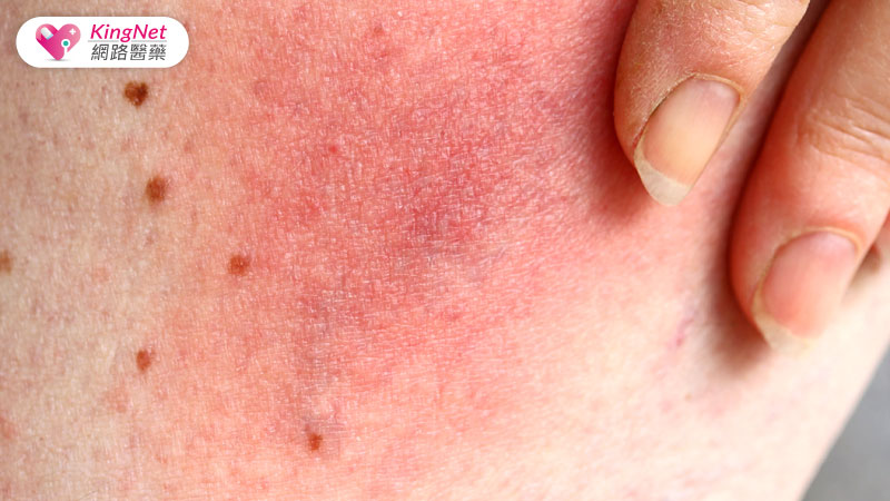 免疫系統皮膚紅斑