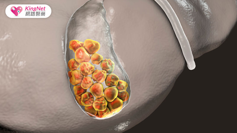 膽囊膽結石
