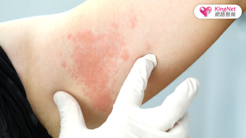 過敏蕁麻疹