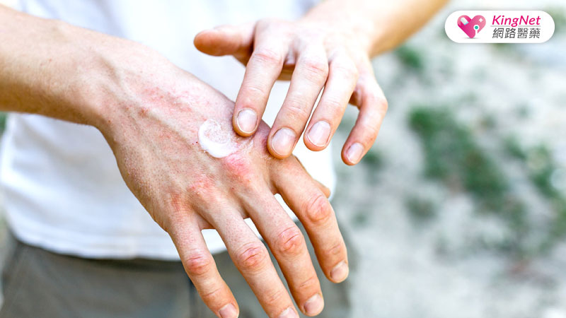 皮膚過敏濕氣