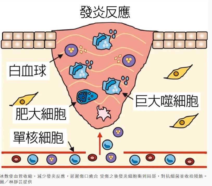 冰敷傷口發炎反應