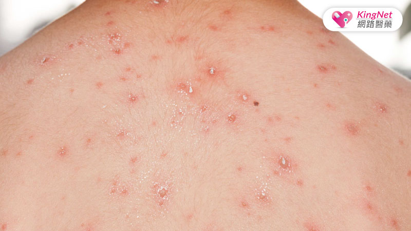 新冠疫苗副作用