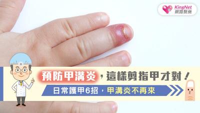 預防甲溝炎，這樣剪指甲才對！日常護甲6招，甲溝炎不再來...