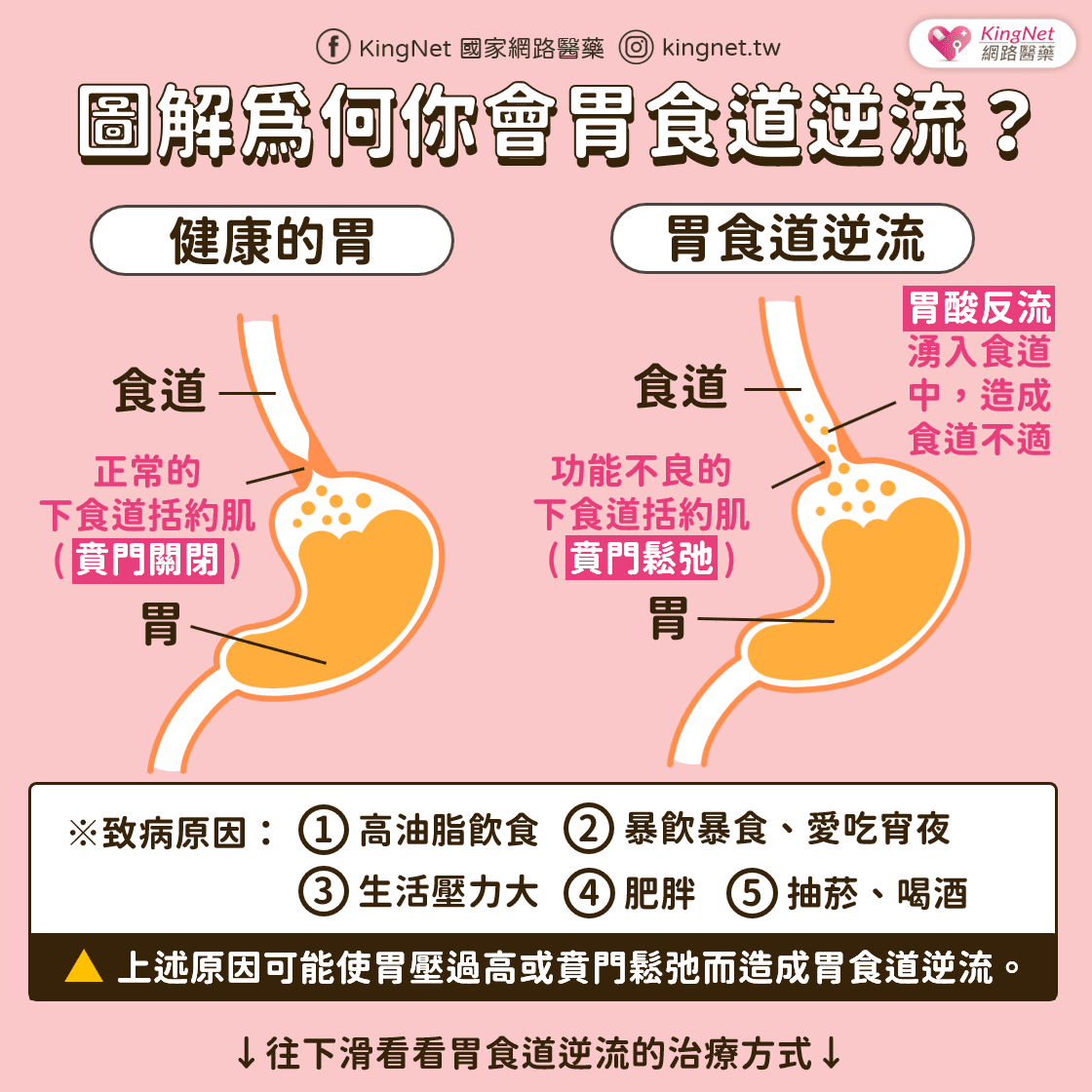 胃食道逆流的原因