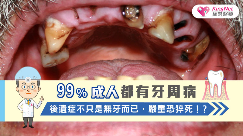 99％成人都有牙周病，後遺症不只是無牙而已，嚴重恐猝死！？