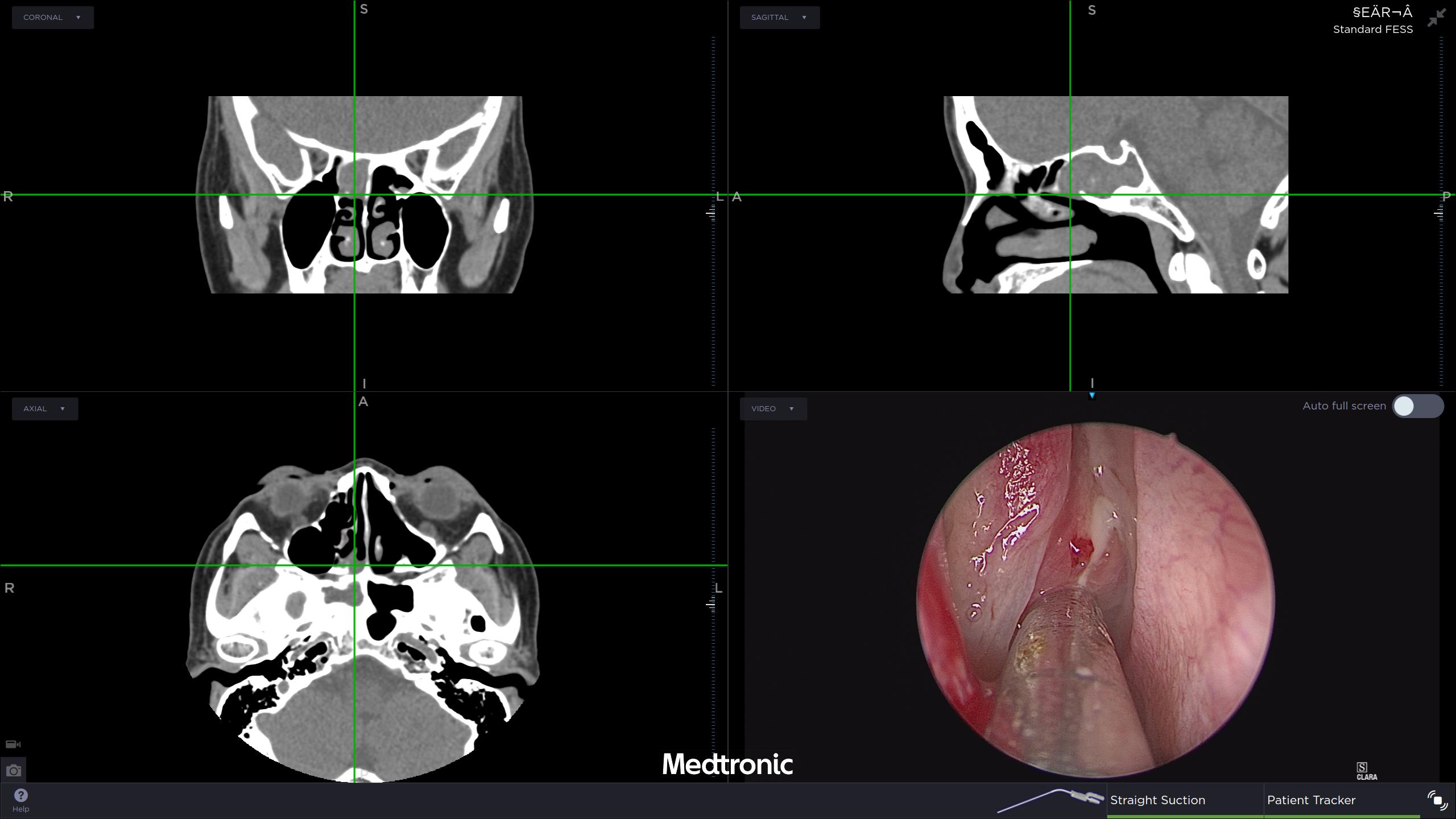 鼻竇內視鏡手術