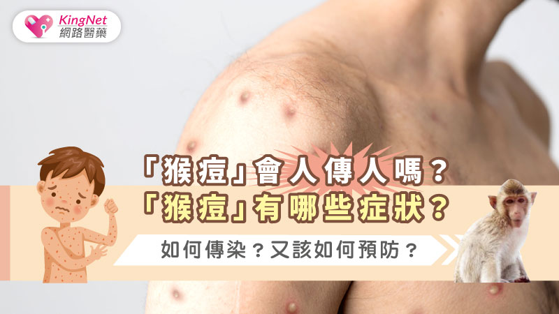 「猴痘」會人傳人嗎？「猴痘」有哪些症狀？如何傳染？又該如何預防？_圖1