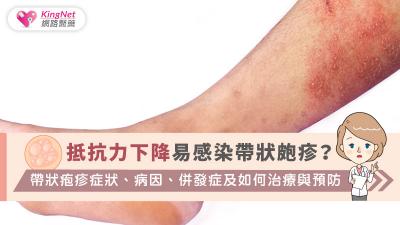 抵抗力下降易感染帶狀皰疹？ 帶狀疱疹症狀、病因、併發症及如何治療與預防