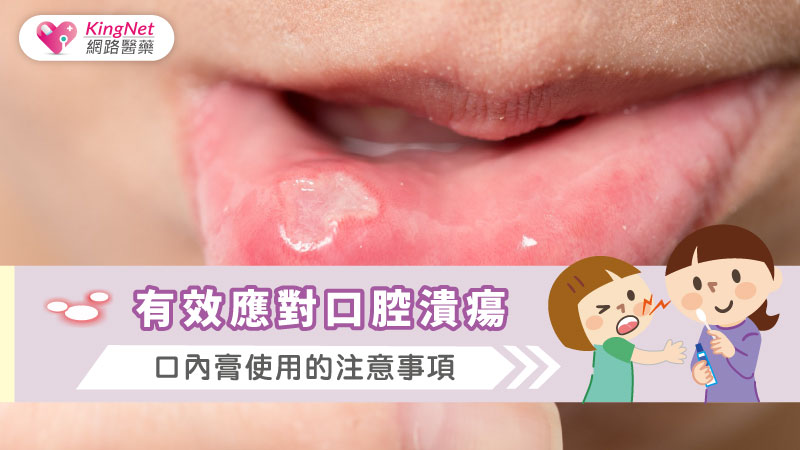 有效應對口腔潰瘍，口內膏使用的注意事項_圖1