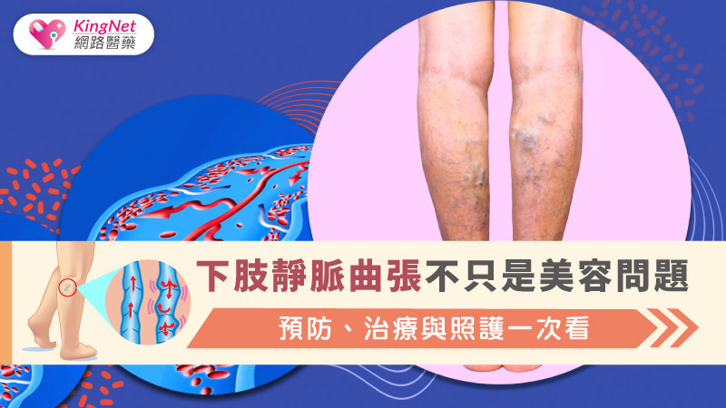 下肢靜脈曲張不只是美容問題：預防、治療與照護一次看_圖1