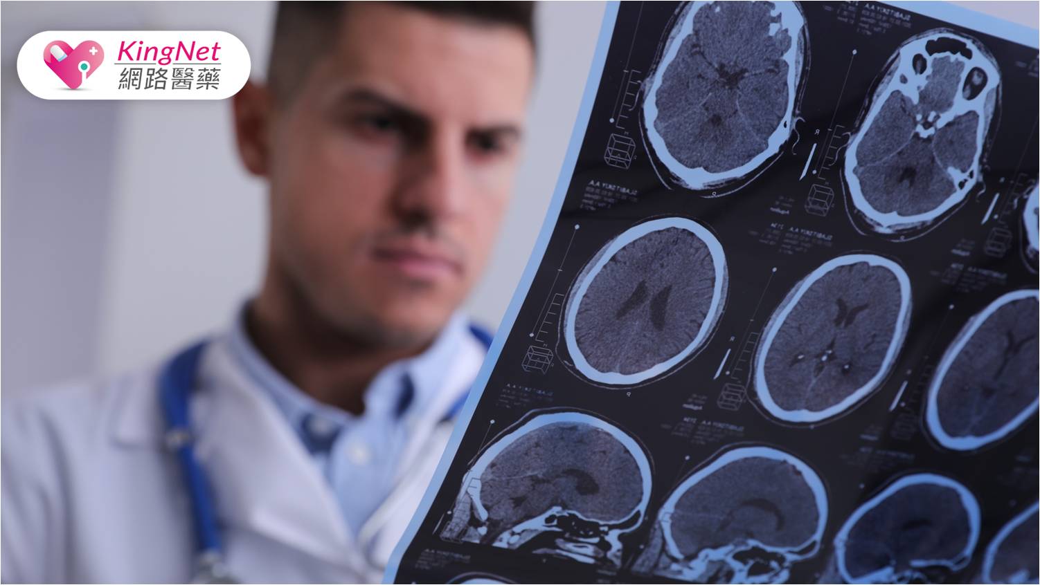 腦中風警訊不容忽視：如何辨識早期徵兆並防範風險_圖1