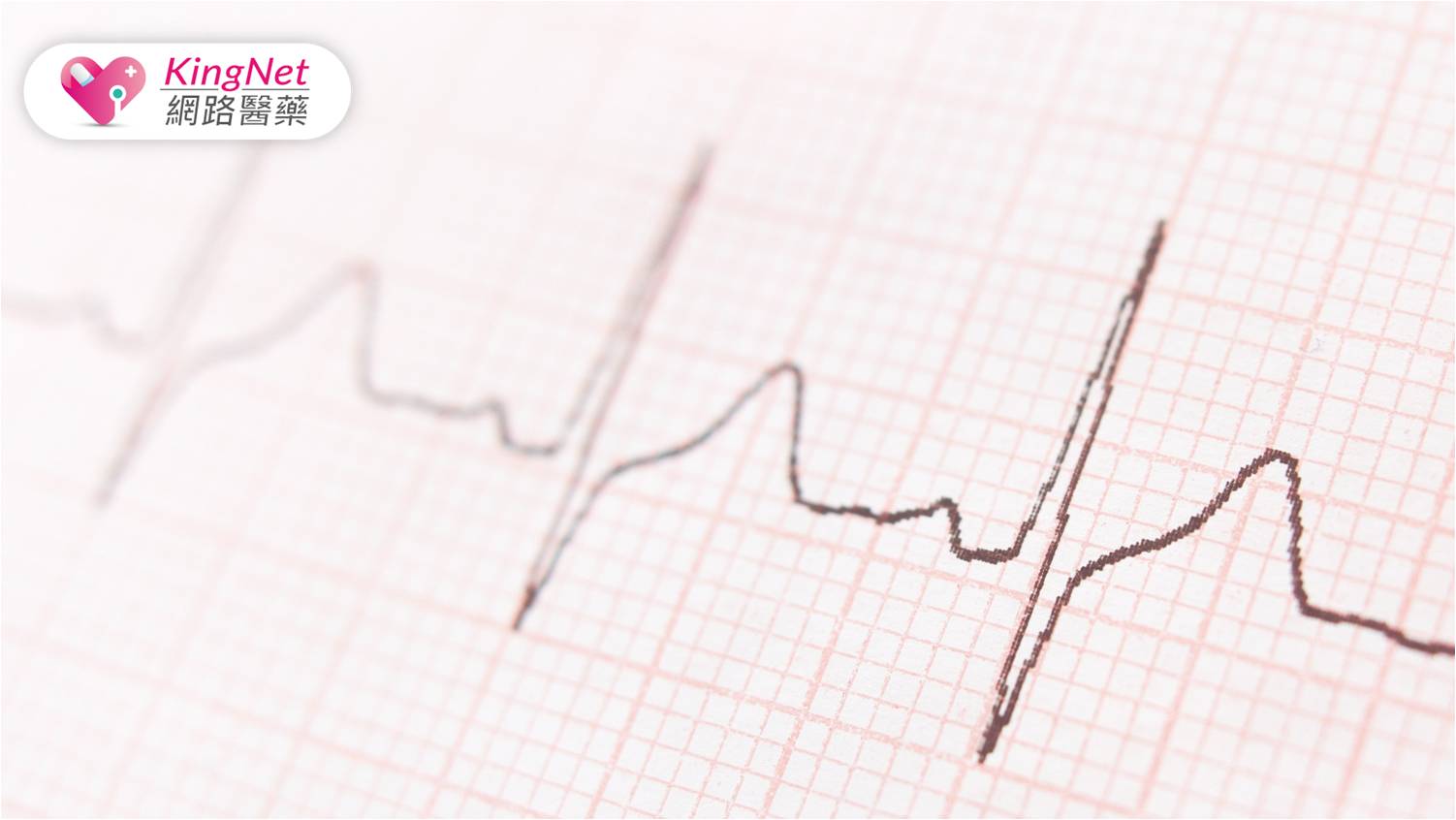 心房顫動全解析：識別、治療與生活調整的關鍵策略_圖1