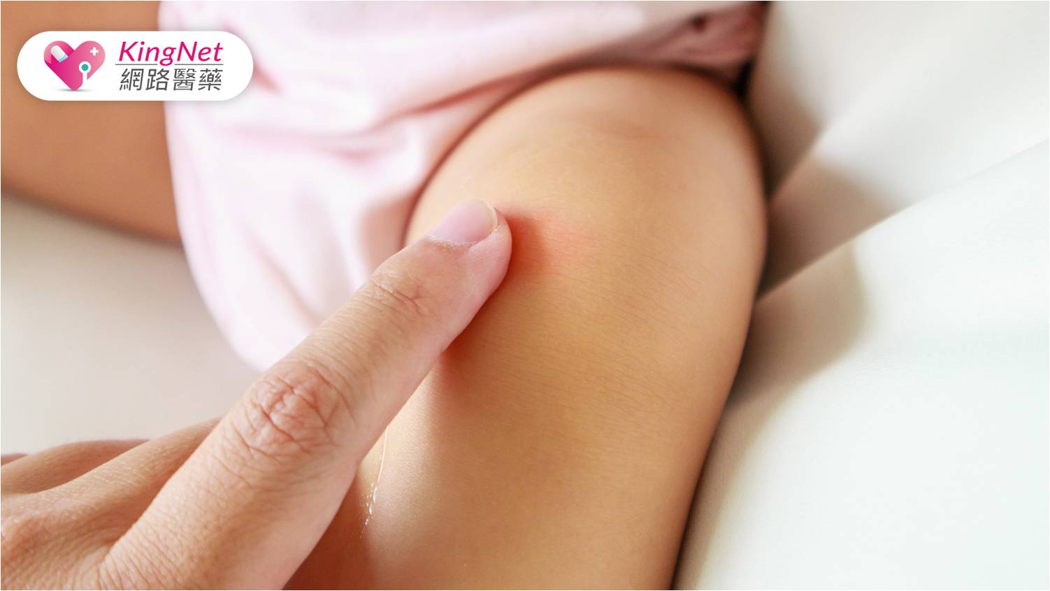 女高中生異膚狂發作、癢到影響學業！醫：5招降低復發率_圖1