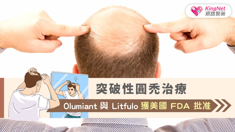 突破性圓禿治療：Olumiant與Litfulo獲美國FDA批准