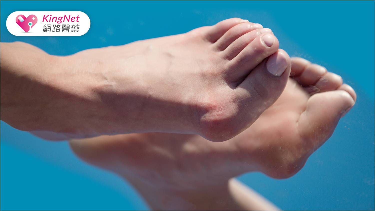 穿高跟鞋拇趾外翻痛到像火在燒，未治療可能引發全身骨骼、關節問題_圖1