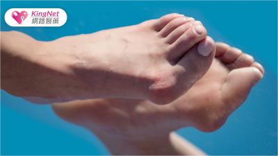 穿高跟鞋拇趾外翻痛到像火在燒，未治療可能引發全身骨骼、關節問題