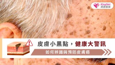 皮膚小黑點，健康大警訊：如何辨識與預防皮膚癌