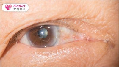 輕微白內障也不可掉以輕心！醫師傳授「4招」延緩症狀