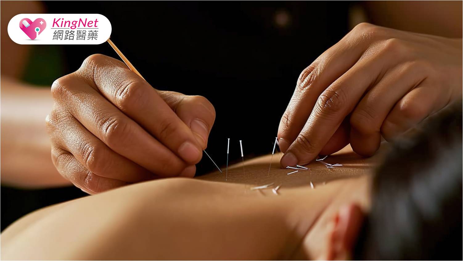 中醫小針刀療法，輔助治療五十肩，縮短治療與康復時間！_圖1