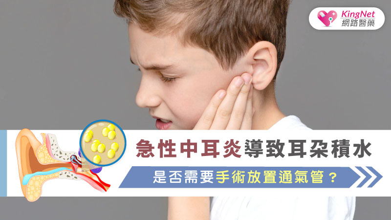 急性中耳炎導致耳朵積水，是否需要手術放置通氣管？_圖1