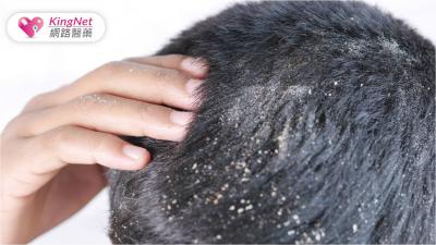 頭皮屑很困擾！醫師曝要對症下藥才有用