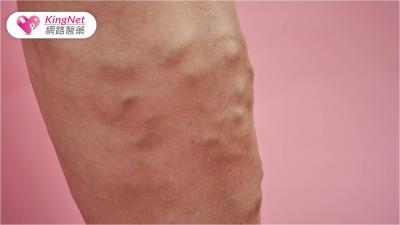 「靜脈曲張」好痛苦？　「靜脈超級膠水」可治癒！ 